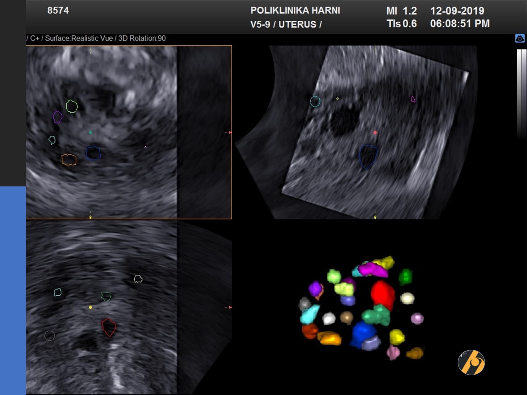 2-5d-folikulomterija-pcos.jpg