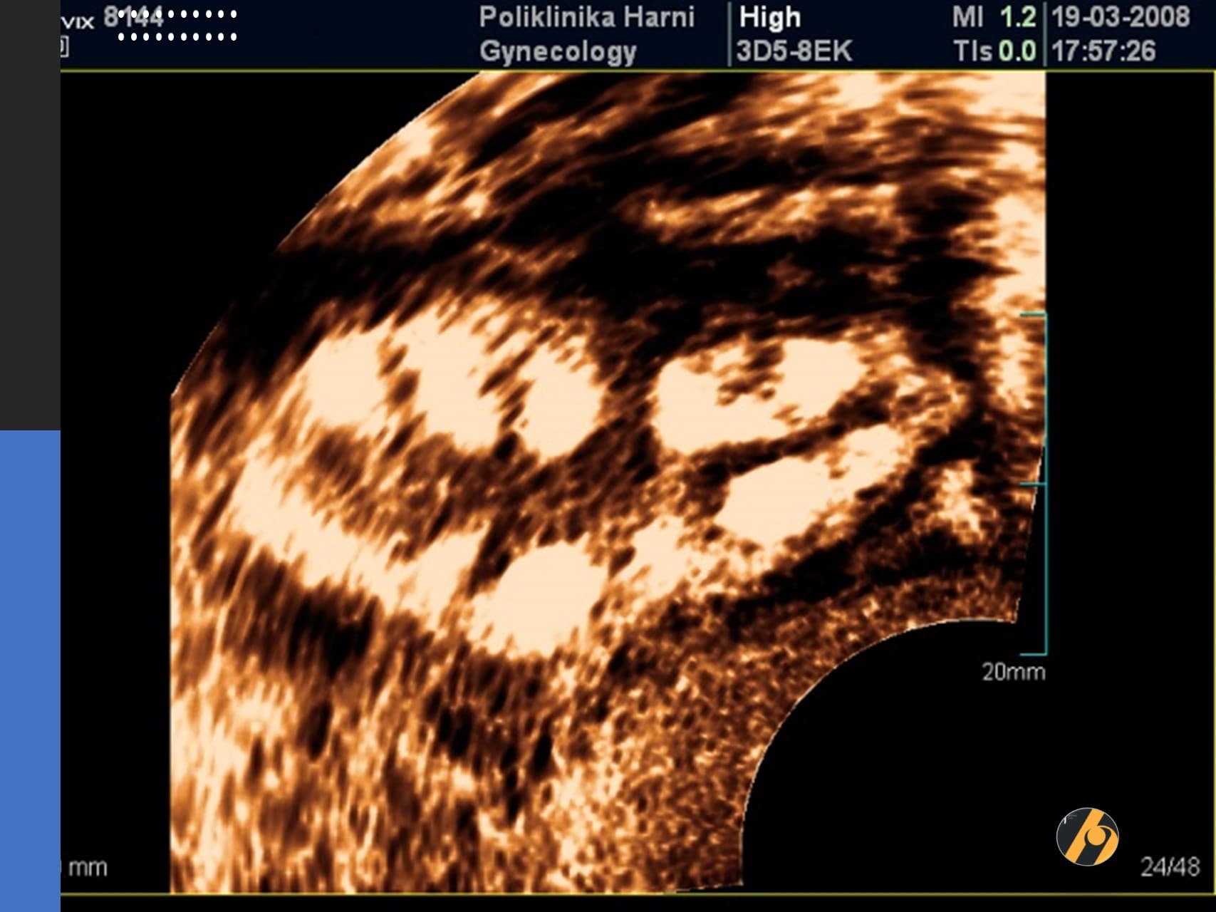 6-inverzija-pcos.jpg