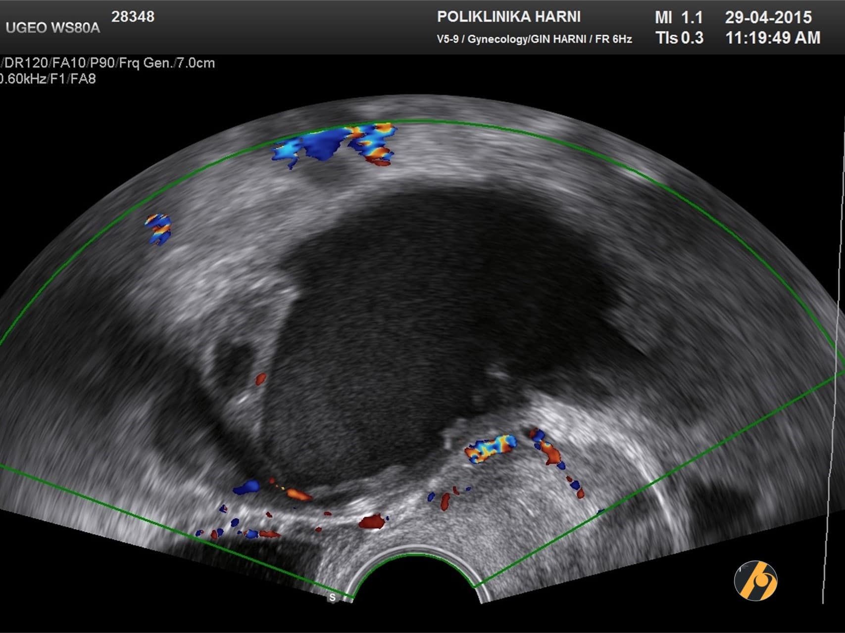 2-endometriom-cd.jpg