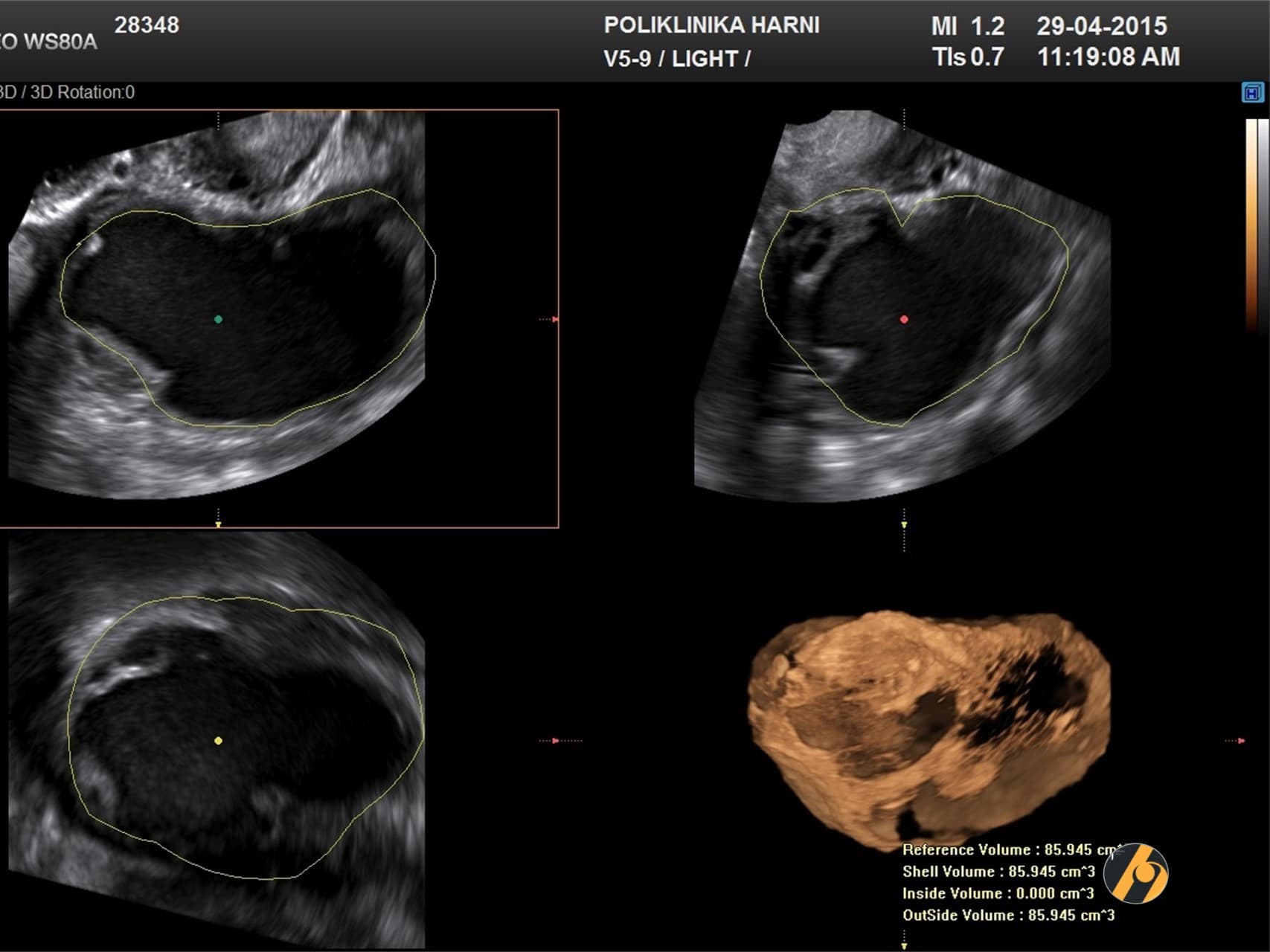 4-rekonstrukcija-endometrioma_u_3-ravnine.jpg