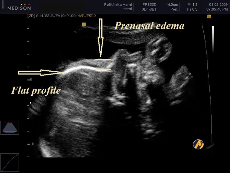 t21-flat-profile.jpg