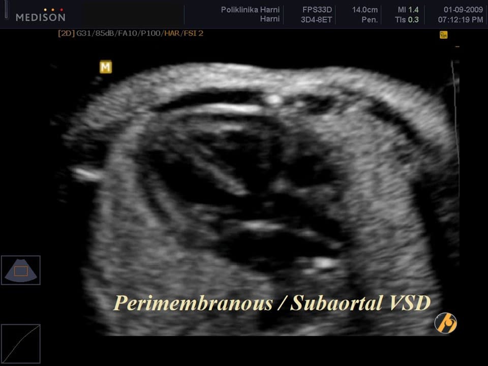 t21-perimembranozni-vsd.jpg