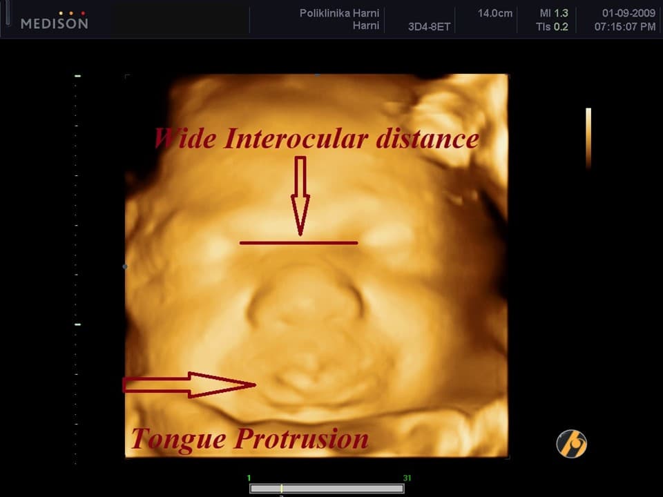 t21-protruzija-jezika.jpg