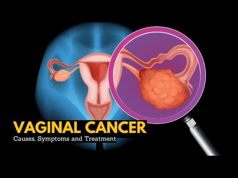 Karcinom vagine