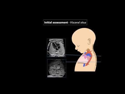 Srčane anomalije u fetusa: Kako prenatalna dijagnoza spašava živote