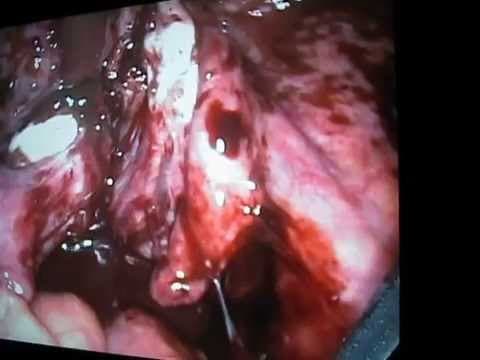 "Kissing ovaries" – znak teške endometrioze