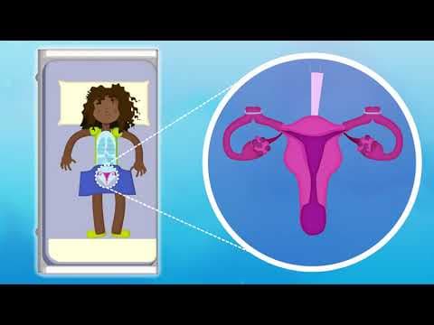 Sterilizacija jajovoda i seksualni problemi