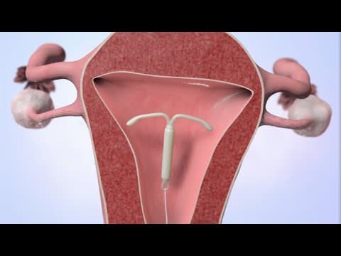 LNG-IUD blokira penetraciju spermija