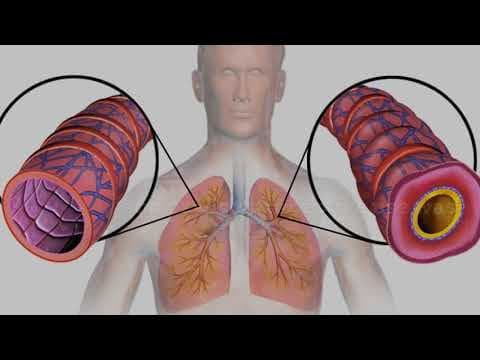 Oralna kontracepcija i BMI povećavaju rizik astme