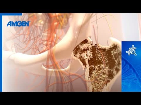 Osteoporoza