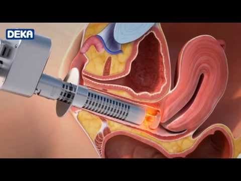 Laserska terapija vaginalne suhoće